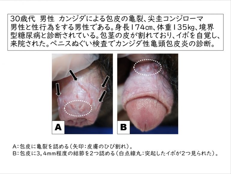 包茎の種類はいくつある？代表的なものと原因で分類される包茎を解説 | 包茎手術のノーストクリニック【公式】