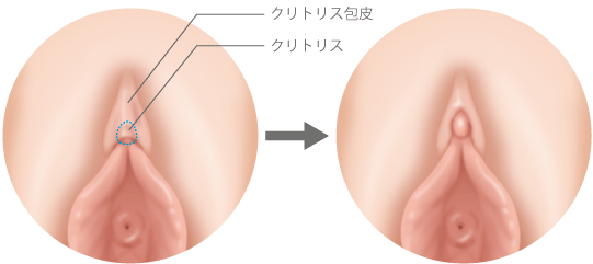 クリトリス包茎術 | 池袋皮フ科形成外科