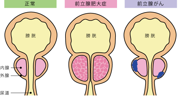 男性型ドライオーガズムができるようになりましたが、あまり安定しません。前立腺に器具が当たって気持ちいい感覚がしっ | Questionbox