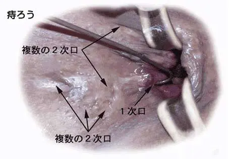 アナニーした次の日軟便や下痢になります。 どうすれば防ぐことができますでしょうか？ |