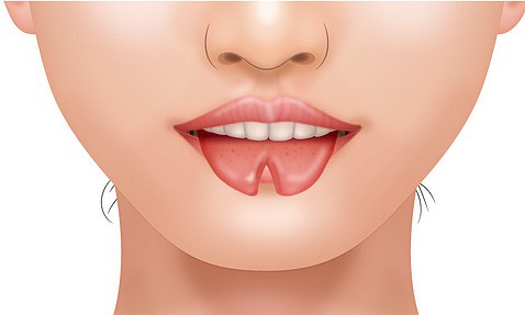 額にシリコンの角、舌先が裂けるスプリットタン…身体改造続ける理由