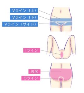 ハイジニーナ脱毛で後悔した？VIOをパイパンにした女性601人の本音調査！ | ミツケル