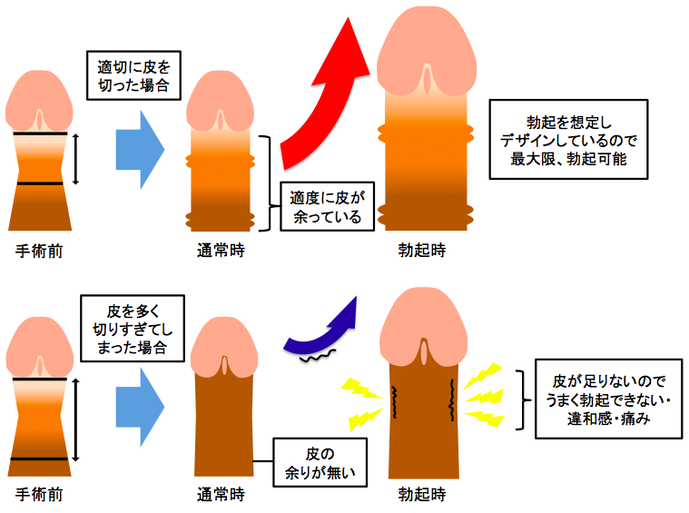 仮性包茎とは｜上野クリニック