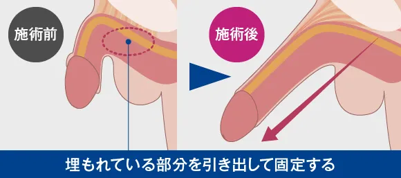 ペニスを長く太く！増大チントレ方法４選【亀頭・竿】