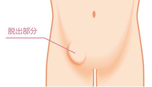 え？太ももの付け根に膨らみと違和感？！西宮敬愛会病院の鼠径ヘルニア専門の「COKU」で聞いてきた【にしつー広告】 | 西宮つーしん