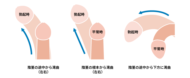 ペニスが曲がってる原因と治し方。お金をかけずにまっすぐに治す！ | VOLSTANISH