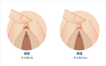 クリトリス包茎｜あんぬクリニック-女性器,女医,婦人科,美容外科,福岡