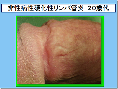 泌尿器科専門医 ドクター尾上の医療ブログ: 【性器の悩み】