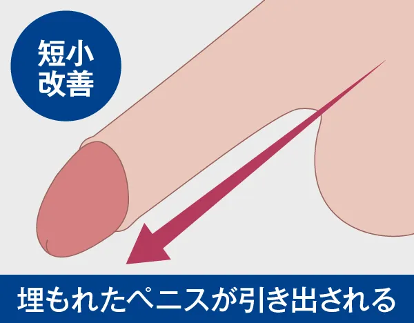 ちんこを太くしたい男性にオススメ！即効性・安全性の高い方法を解説。 | 【フェアクリニック】包茎・薄毛・男の悩み相談所