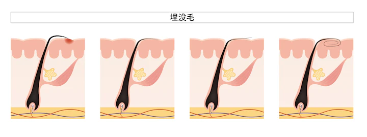 髪の毛を抜くとはげる？癖や病気で抜き続けるリスクやまた生えてくるかも解説 | 育毛のミカタ