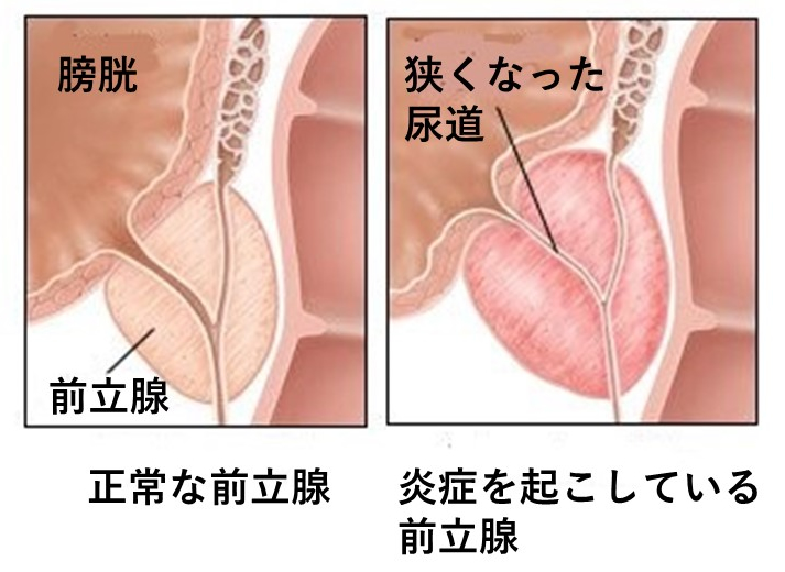 カテーテル 限界まで膨らんだ膀胱 おしっこ我慢