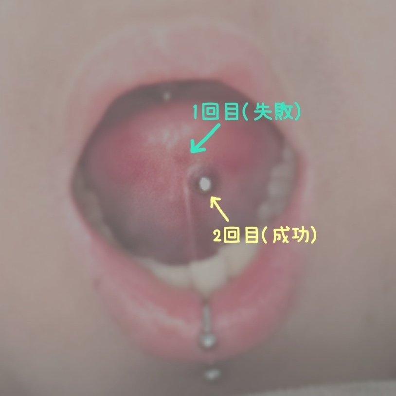 ちょん仔さんの舌の裏のボディピアス / タンウェブ: