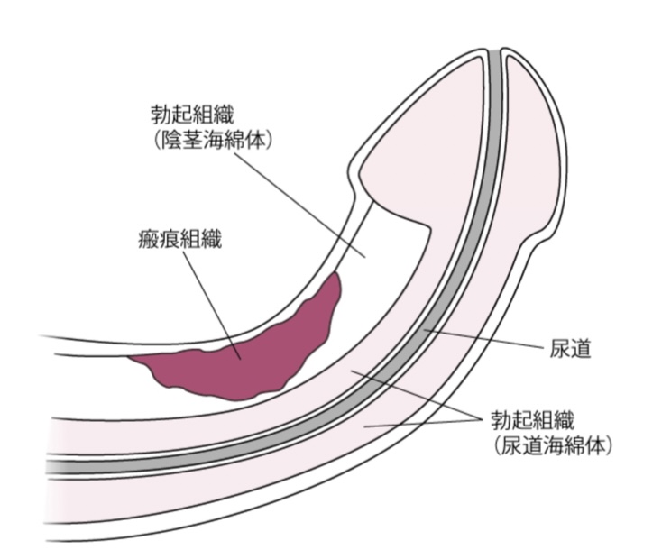 泌尿器科専門医 ドクター尾上の医療ブログ: 【性器の悩み】