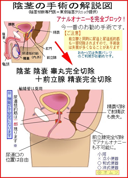 精管切断術（パイプカット） | 英（はなぶさ）メンズクリニック｜