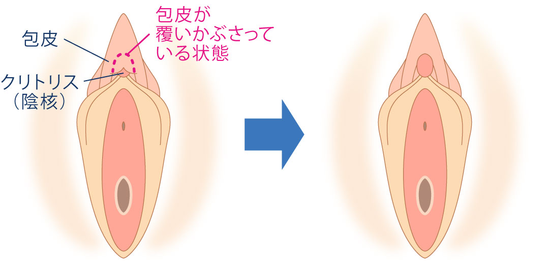 クリトリス包茎手術｜見た目・感度を改善！女性器整形「クリトリス包茎手術」の効果・経過・ダウンタイムとは｜美容整形・美容外科のTAクリニックグループ