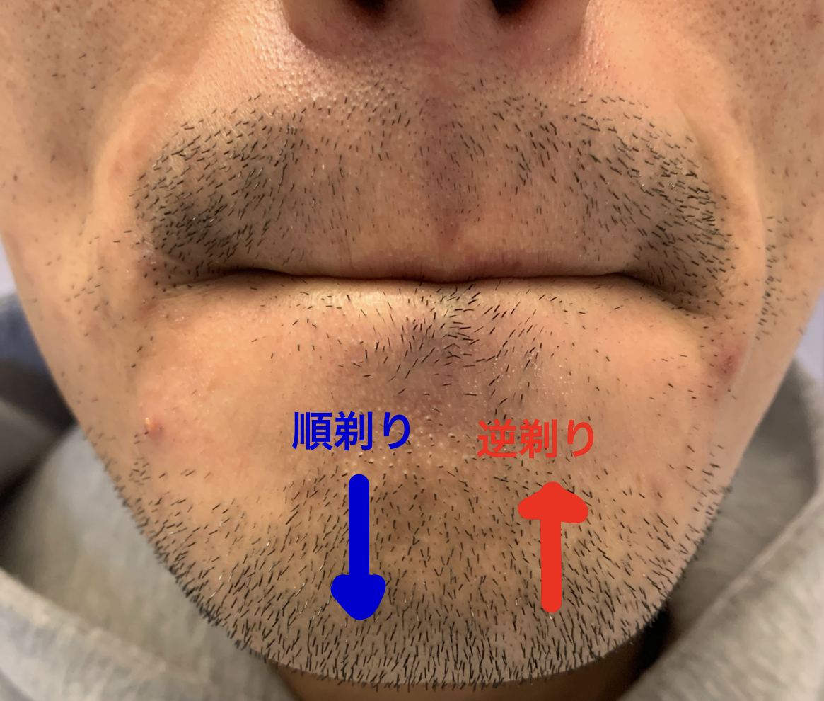 実体験】中学生からヒゲを抜き続けたら薄くなった話【30代まで】