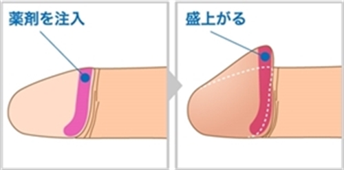 包茎治療｜仮性・カントン・真性包茎｜札幌中央クリニック