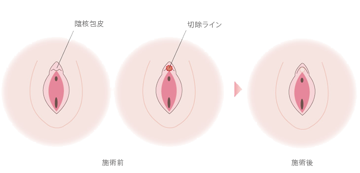 陰部(女性）のできもの・しこりの原因と検査、治療薬（画像あり）|天神マイケアクリニック