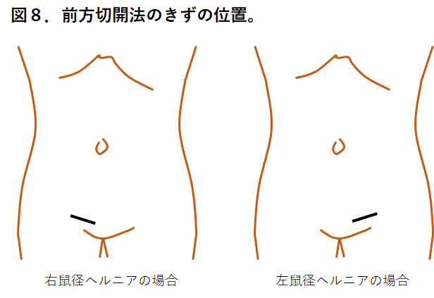 え？太ももの付け根に膨らみと違和感？！西宮敬愛会病院の鼠径ヘルニア専門の「COKU」で聞いてきた【にしつー広告】 | 西宮つーしん