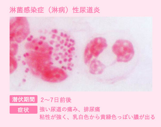尿道炎とは｜なりた泌尿器科・内科クリニック｜千葉県流山市の泌尿器科専門医