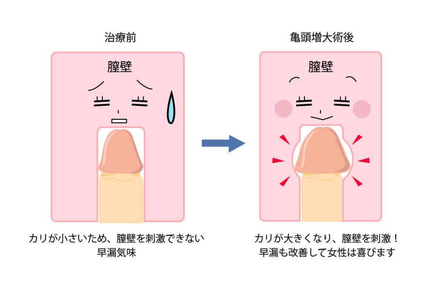 包皮の亀裂/断裂｜夜間頻尿: 原因と正体のオリジナルな考え方、治療、指導法 | 当院のオリジナルな知識で援助