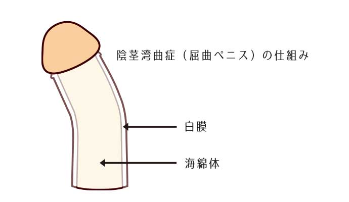 短小包茎とは！短小は何センチから？日本人の平均サイズや治療法 - アトムクリニック - atom-clinic