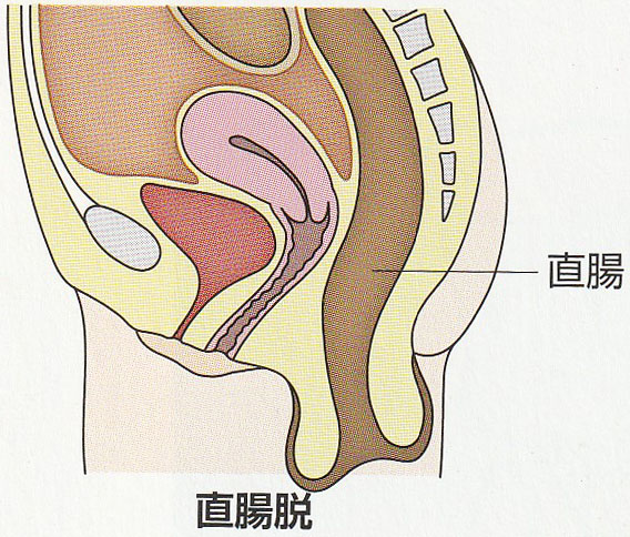 その熱は本当に発熱外来?お尻が腫れて熱が出るのは肛門科へ。｜江東区「東大島駅」の苦痛のない胃・大腸カメラ、日帰りポリープ切除・肛門科手術