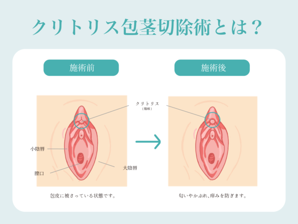 陰部のかゆみ】デリケートゾーンがかゆいのは膣カンジダ？原因をチェック｜wakanote