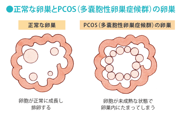 妊娠超初期症状はいつからはじまる？受精から着床まで【医師監修】出生前診断とはデメリット受ける割合30 代前半20代後半