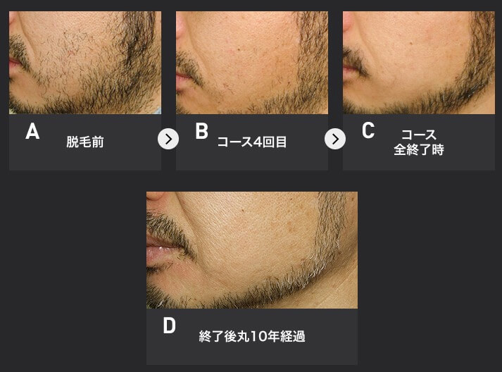 メンズTBCの脱毛の口コミ・評判を調査！料金が高すぎる？メリットやデメリットなども紹介