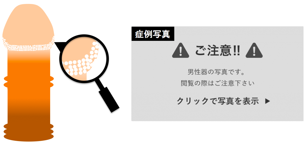 シリコンボールが登場する前はペニスに「真珠」を埋めていたって本当？ - アモーレクリニック