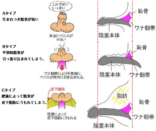 短小の基準は？短いちんこのちん長を伸ばし、粗チンを卒業する方法まとめ | Men's