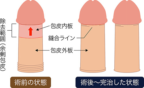 泌尿器科医が徹底解説】切る・切らない全４種類の長茎術を徹底比較