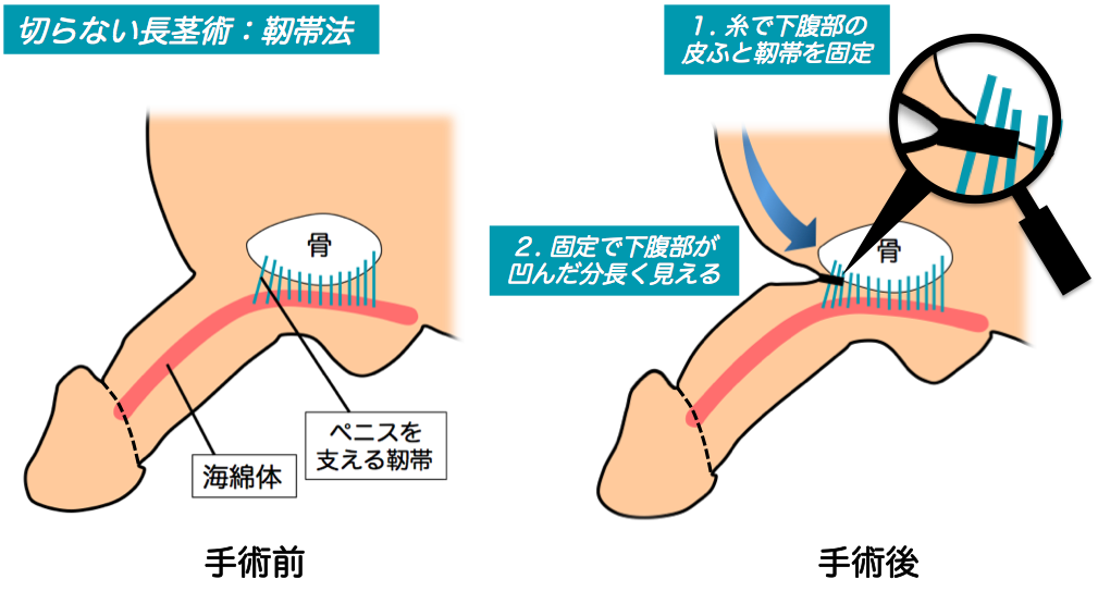 長茎治療（ペニスを長く）｜札幌中央クリニック