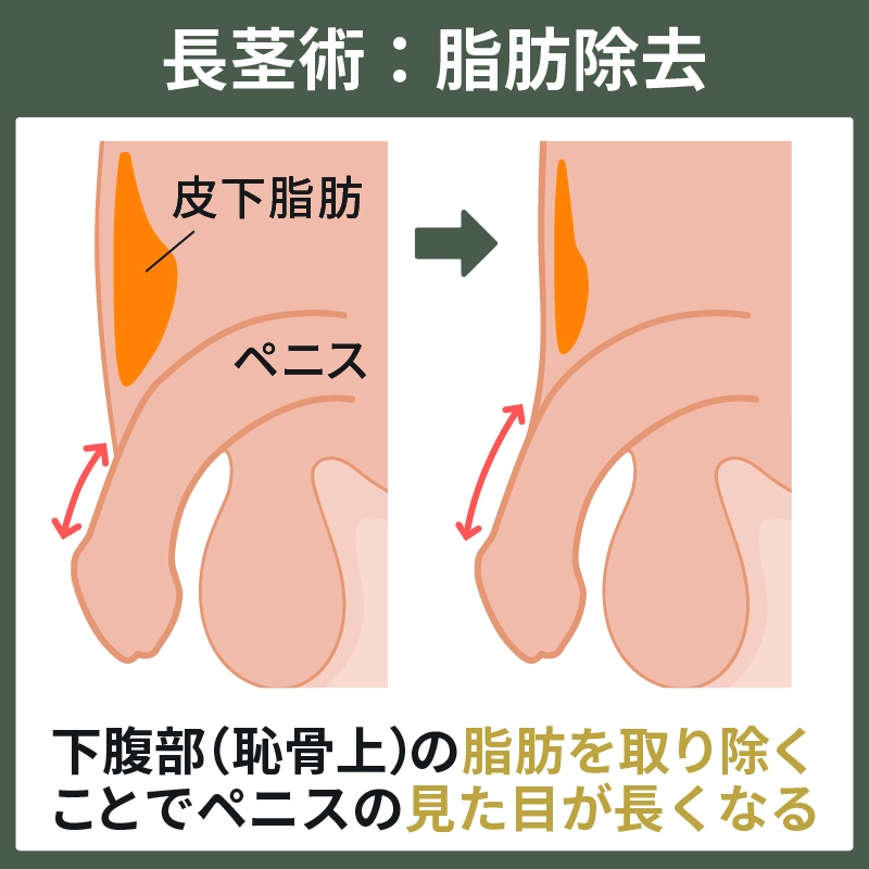 検証】デブのチンコが小さい噂は本当？肥満と短小の関係10つ | STERON