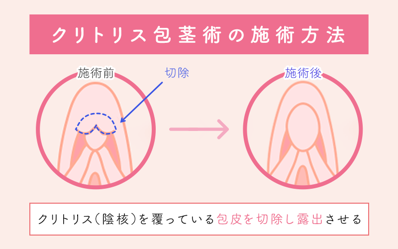 副皮・クリトリス包茎 | 東郷美容形成外科 福岡｜福岡・博多駅前で美容外科・美容整形なら