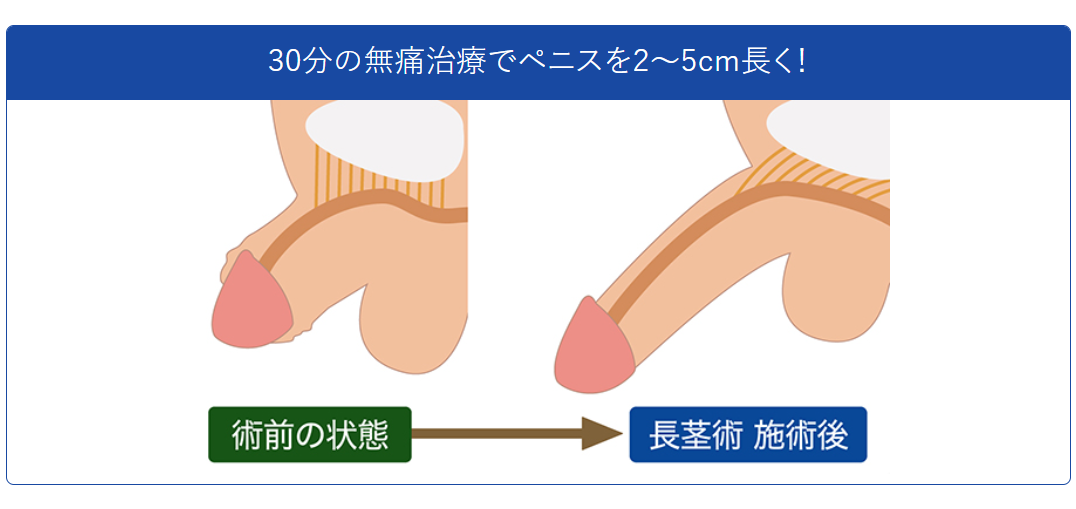 有楽町美容外科クリニック：長茎術