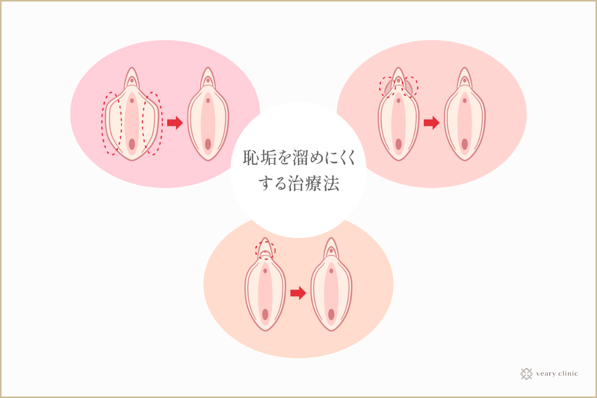 クリトリスや陰部にニキビのような白いできもの？ | 【きもイク】気持ちよくイクカラダ