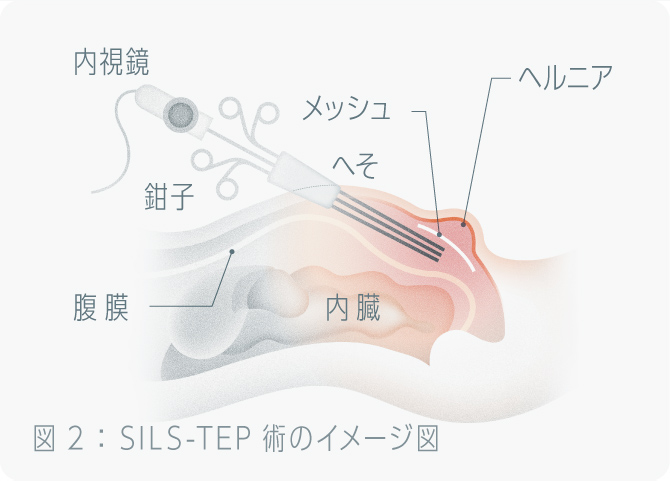 鼠径部（そけいぶ）とは？場所や起こる病気をわかりやすく解説！｜ブログ｜Gi外科クリニック