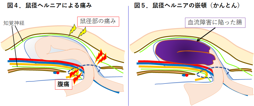 え？太ももの付け根に膨らみと違和感？！西宮敬愛会病院の鼠径ヘルニア専門の「COKU」で聞いてきた【にしつー広告】 | 西宮つーしん