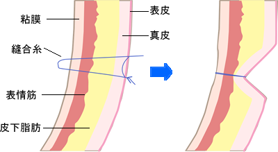 骨盤矯正】美人の条件？！骨盤のえくぼ（ヴィーナスのえくぼ・アポロのえくぼ） | 