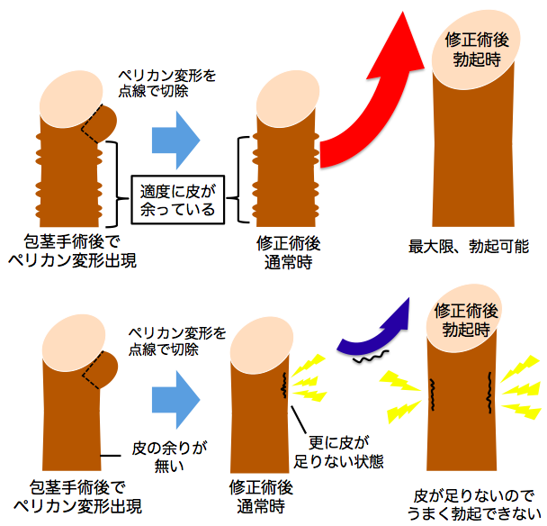 仮性包茎矯正 勃起不全 早漏改善 防止 ペニス