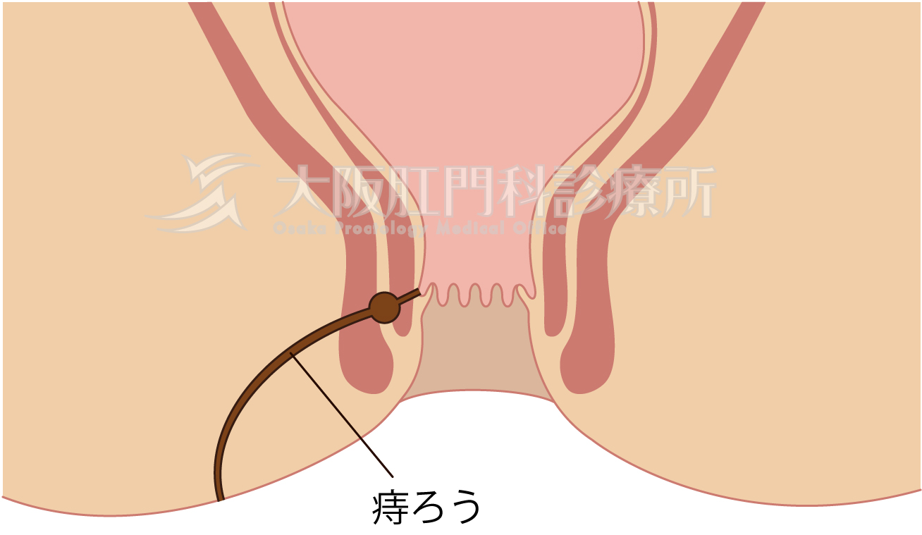 おしりの毛でオナラの音は消せるのか問題。 | RadiChubu-ラジチューブ-