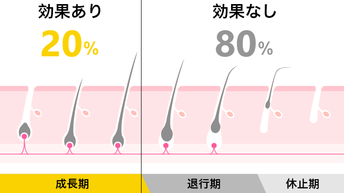 女性にもひげが生える？ひげの原因や対策、脱毛初心者が注意すべきポイントを解説！ - 銀座・名古屋・心斎橋の美肌治療は椿クリニック