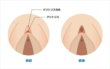 膣の位置は年齢で変わる！？上付き、下付きについて婦人科医に聞きました。 | ランドリーボックス