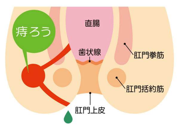 肛門からの出血の状態で、大腸・肛門の病気が分かりますか？｜市民のみなさまへ｜日本大腸肛門病学会