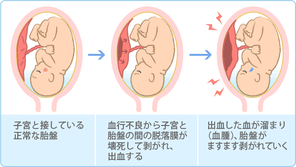 最も肌を傷つけないはがし方とは？｜フィルムドレッシングで実験 ！｜skinix（スキニックス）