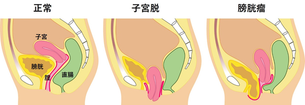 腟ナラ】セックス中や運動中に「腟からおならが出る」これって何？改善できるの？泌尿器科医に聞いた | ヨガジャーナルオンライン