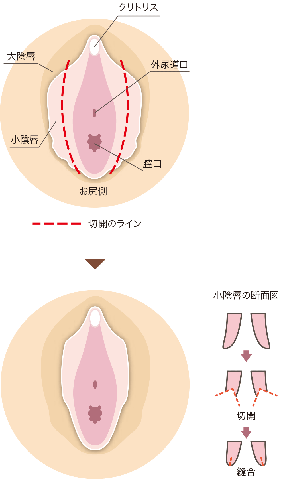 【クリトリス包茎】女性の包茎って何！？陰核包茎を徹底解説！【女性器の悩み】