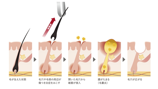 髭に白髪が30代で生える7つの原因！簡単な隠し方とケアが不要な方法 | ヒゲ脱毛ガイド